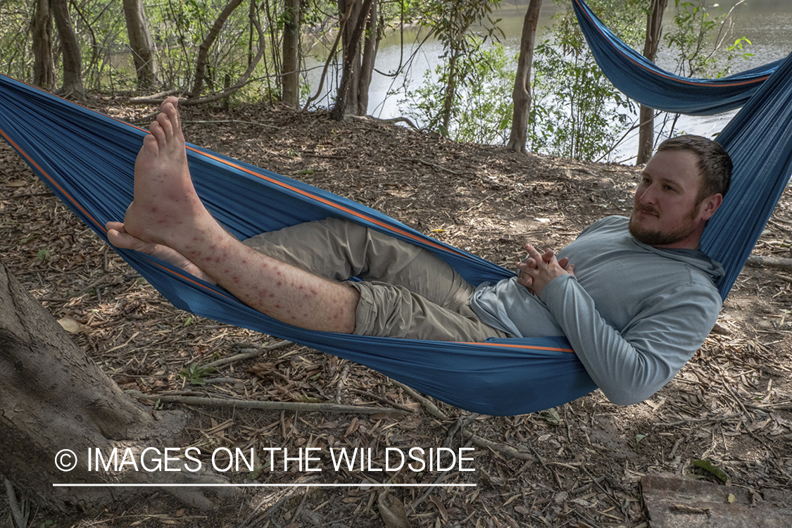 Flyfisherman in hammock showing off bug bites.